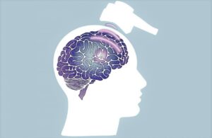 transcranial magnetic stimulation for migraines