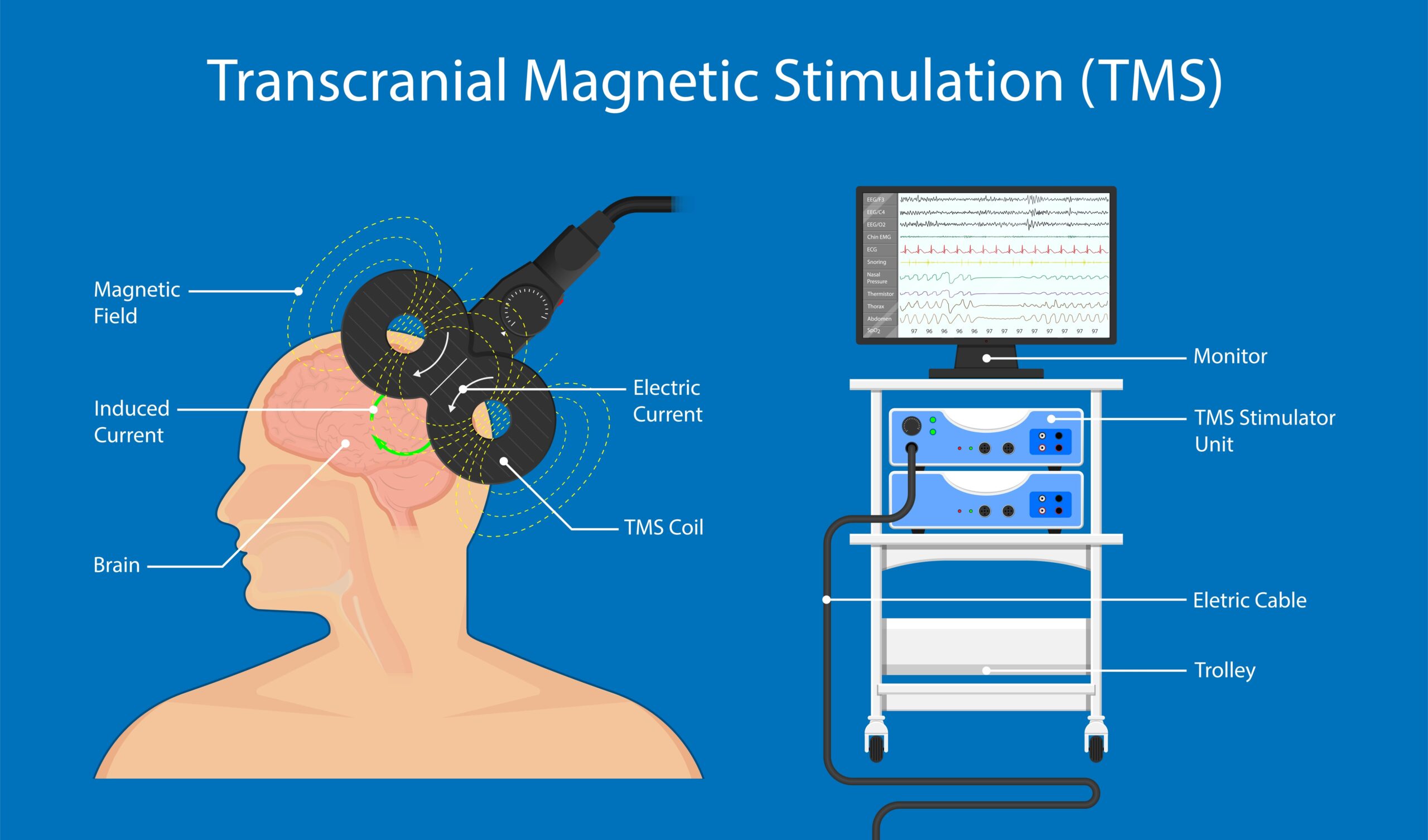 Transcranial Magnetic Stimulation (TMS) Therapy